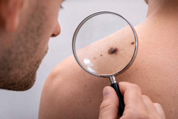 Онколог Стилиди рассказал, почему не стоит удалять родинки «про запас»