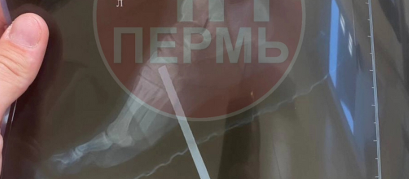 В медучреждении Октябрьского округа пострадавшему назначили только обезболивающее и антибиотики